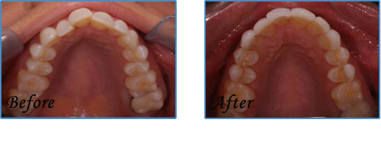 After treatment